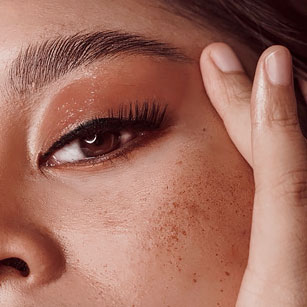 Fraxel Laser 2 SKINTYTE LASER TREATMENT